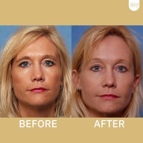 Before and after Deep Plane Facelift results at ID Clinic Bangkok, facial rejuvenation outcome