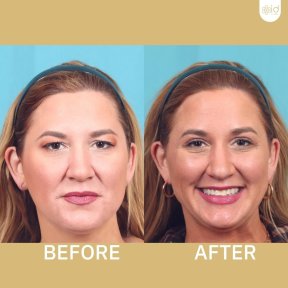 Before and after deep plane facelift results at ID Clinic Bangkok, facial rejuvenation outcome