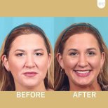 Before and after deep plane facelift results at ID Clinic Bangkok, facial rejuvenation outcome