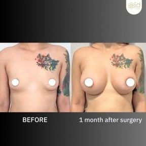 Результати збільшення грудей до і після в ID Clinic Bangkok, помітне збільшення об'єму