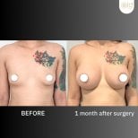 Результати збільшення грудей до і після в ID Clinic Bangkok, помітне збільшення об'єму