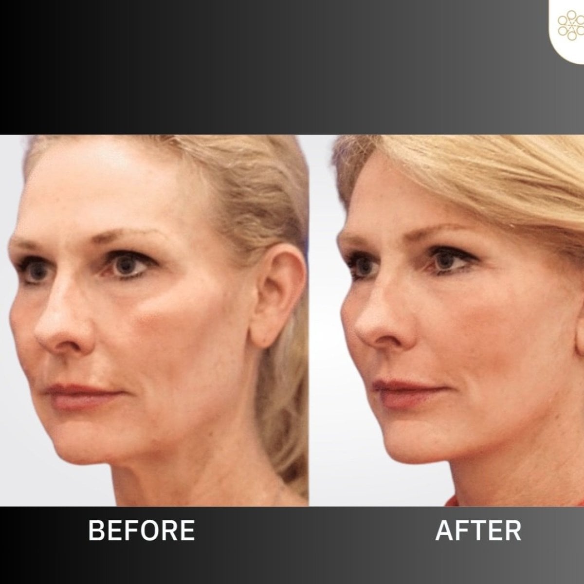 Resultados de minilifting facial antes y después en ID Clinic Bangkok, rejuvenecimiento visible