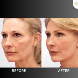 Фото до та після мініпідтяжки обличчя, доктор 