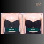 Before and after breast augmentation with silicone implants at ID Clinic Bangkok, visible result