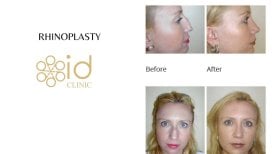 Фото до и после ринопластики (пластики носа), доктор 