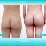 Before and after buttock lift results at Wansiri Hospital, visible contour improvement