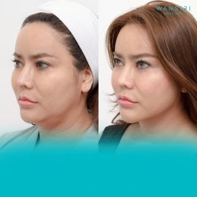 Before and after liposuction at Wansiri Hospital, improved jawline and chin contour result