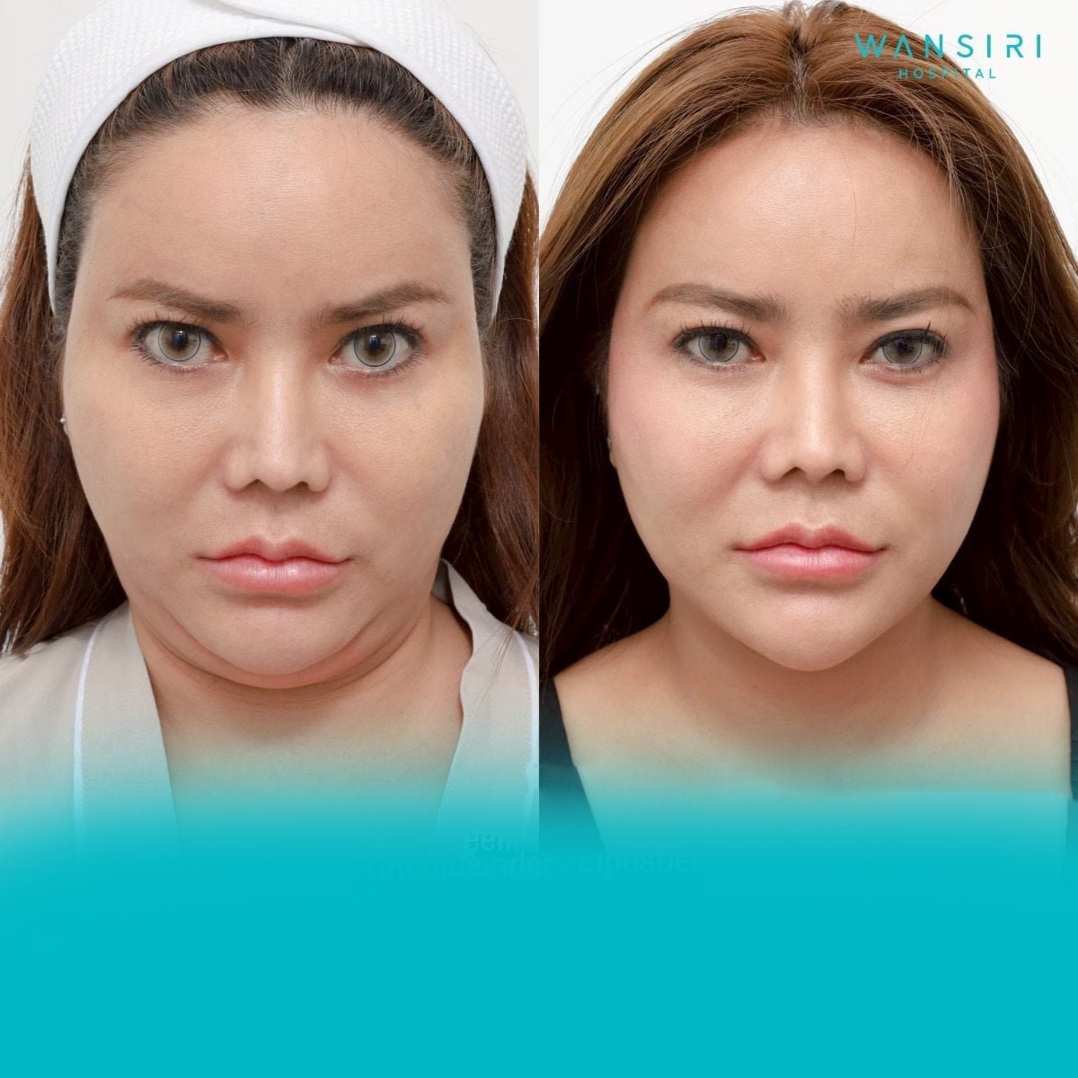 Resultados de liposucción antes y después en Wansiri Hospital, mejora visible del contorno facial