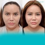 Before and after liposuction results at Wansiri Hospital, improved facial contour visible