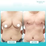 Before and after top surgery results at Wansiri Hospital, chest masculinization procedure