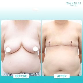 Before and after top surgery results at Wansiri Hospital, chest masculinization procedure