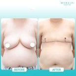 Before and after top surgery results at Wansiri Hospital, chest masculinization procedure