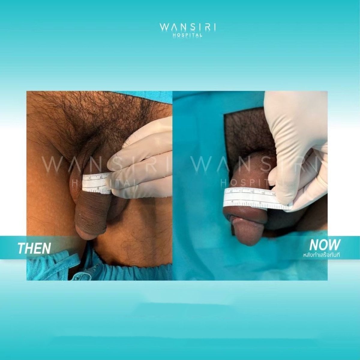 Resultados antes y después de aumento de pene en Wansiri Hospital, mayor grosor visible