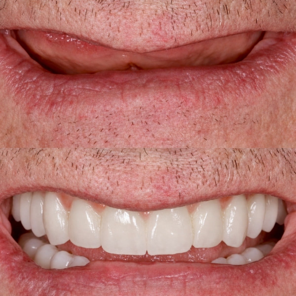 نتائج قبل وبعد زراعة الأسنان في BMC Dental Klinik – استعادة الابتسامة الكاملة