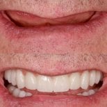 Fotos de antes y después de Implante dental tomadas por el Dr.(la Dra.) 
