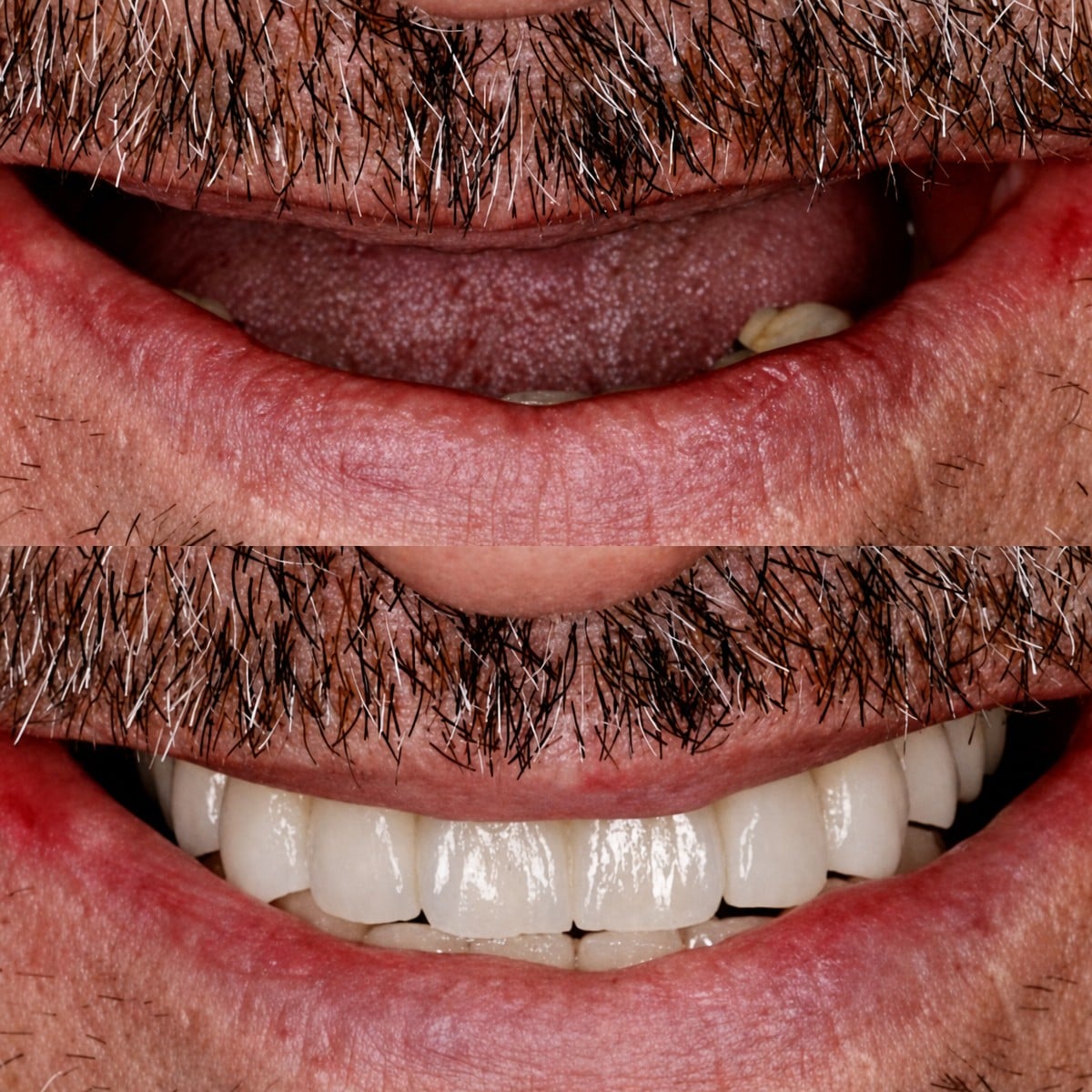 Resultados antes y después de implantes dentales en BMC Dental Klinik, sonrisa restaurada