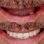 Fotos de antes y después de Implante dental tomadas por el Dr.(la Dra.) 