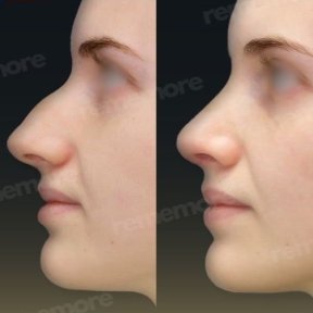 Vorher-nachher-Ergebnis der Nasenkorrektur in Memorial Ataşehir Hospital, Rhinoplastik