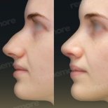 Vorher-nachher-Ergebnis der Nasenkorrektur in Memorial Ataşehir Hospital, Rhinoplastik