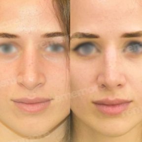 Vorher-nachher-Ergebnis der Nasenkorrektur in Memorial Ataşehir Hospital, Rhinoplastik