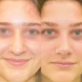 Vorher-nachher-Ergebnis der Nasenkorrektur in Memorial Ataşehir Hospital, Rhinoplastik