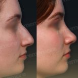 Vorher-nachher-Ergebnis der Nasenkorrektur in Memorial Ataşehir Hospital, Nasenformung