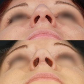 Vorher-nachher-Ergebnisse der Nasenkorrektur im Memorial Ataşehir Hospital, verbesserte Nasenform