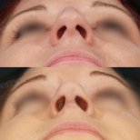 Vorher-nachher-Ergebnisse der Nasenkorrektur im Memorial Ataşehir Hospital, verbesserte Nasenform