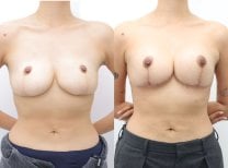 Before and after nipple correction at Wansiri Hospital, improved nipple shape and symmetry result