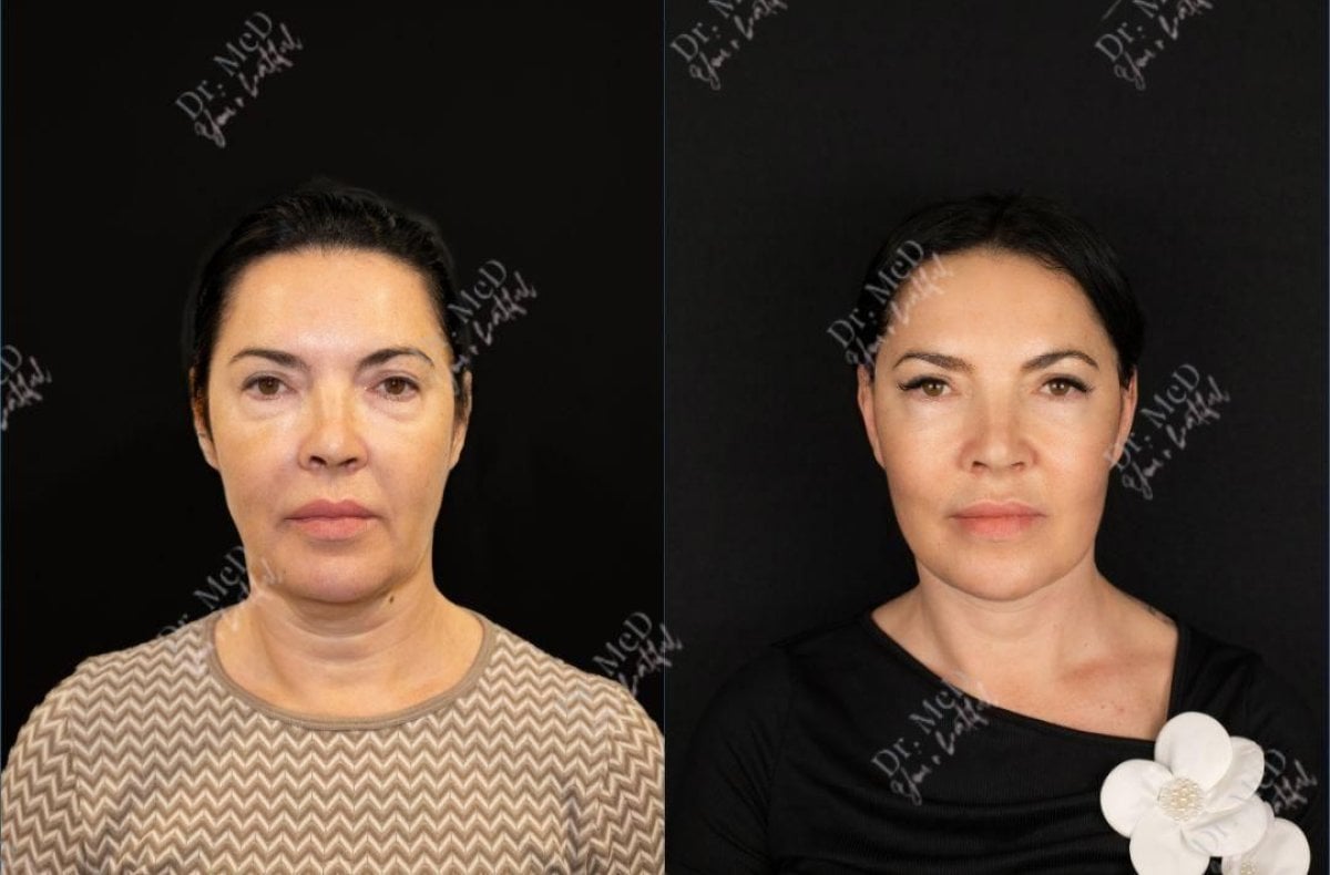 نتائج حقن الدهون للوجه قبل وبعد في Dr. MED – تجديد شباب الوجه واستعادة الحجم