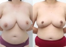 Before and after breast lift results at Wansiri Hospital, improved breast contour and lift