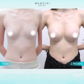 Before and after breast augmentation at Wansiri Hospital, visible enhancement results
