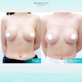 Before and after breast augmentation results at Wansiri Hospital, 2 months post-surgery