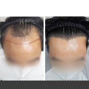 Before and after hair transplant results at Asia Cosmetic Hospital, restored hairline in male patient