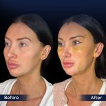 Vorher-nachher-Ergebnis endoskopisches Facelifting bei Dr. Safa Manav Clinic