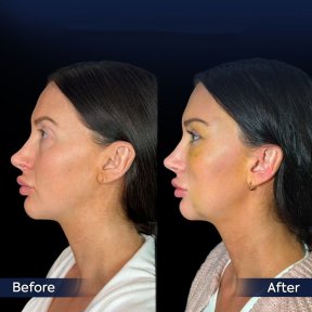 Endoskopisches Facelift Vorher-Nachher-Ergebnis in der Dr. Safa Manav Klinik