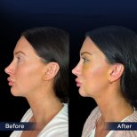 Endoskopisches Facelift Vorher-Nachher-Ergebnis in der Dr. Safa Manav Klinik