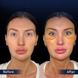 Endoskopisches Facelift Vorher-Nachher-Ergebnis in der Dr. Safa Manav Klinik