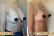 Vorher-nachher-Ergebnis Bruststraffung bei Dr. Safa Manav Clinic, verbesserte Form