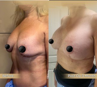 Vorher-nachher-Ergebnis Bruststraffung bei Dr. Safa Manav Clinic, sichtbare Konturverbesserung