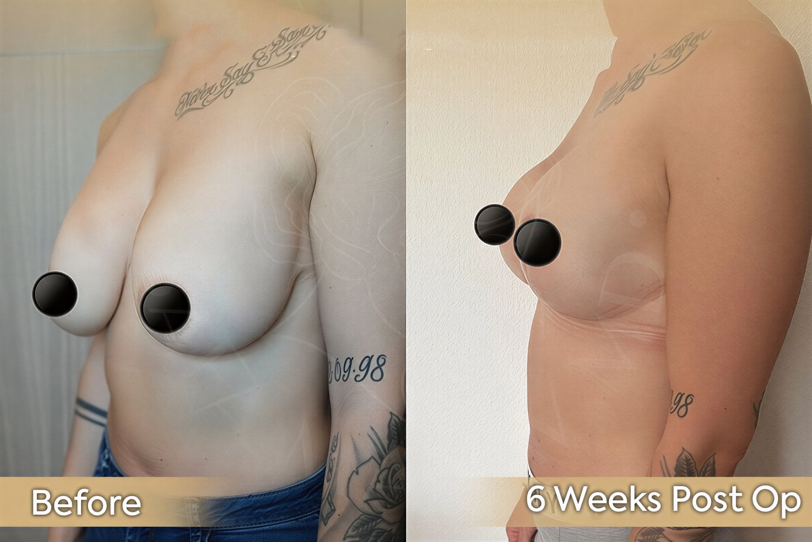 Resultados de lifting de senos antes y después en Dr. Safa Manav Clinic, mejora a 6 semanas