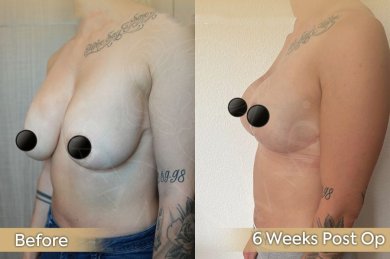 Vorher-nachher-Ergebnis Bruststraffung bei Dr. Safa Manav Clinic, Verbesserung nach 6 Wochen