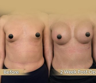 Vorher-nachher-Ergebnis Bruststraffung bei Dr. Safa Manav Clinic, verbesserte Brustform