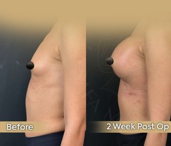 Vorher-nachher-Ergebnis Bruststraffung bei Dr. Safa Manav Clinic, Verbesserung nach 2 Wochen