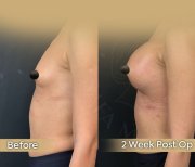 Vorher-nachher-Ergebnis Bruststraffung bei Dr. Safa Manav Clinic, Verbesserung nach 2 Wochen