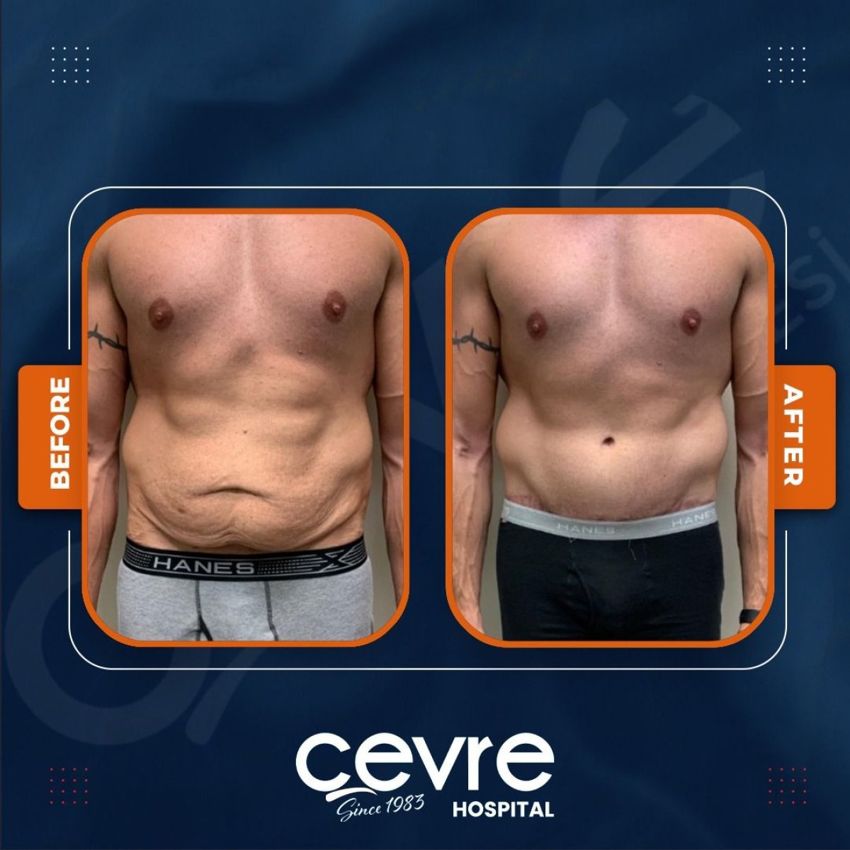 Resultados de abdominoplastia y liposucción antes y después en Adem and Havva Medical Center