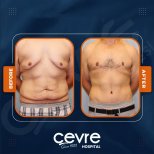 Vorher-nachher-Ergebnisse Bauchdeckenstraffung und Fettabsaugung bei Adem and Havva Medical Center