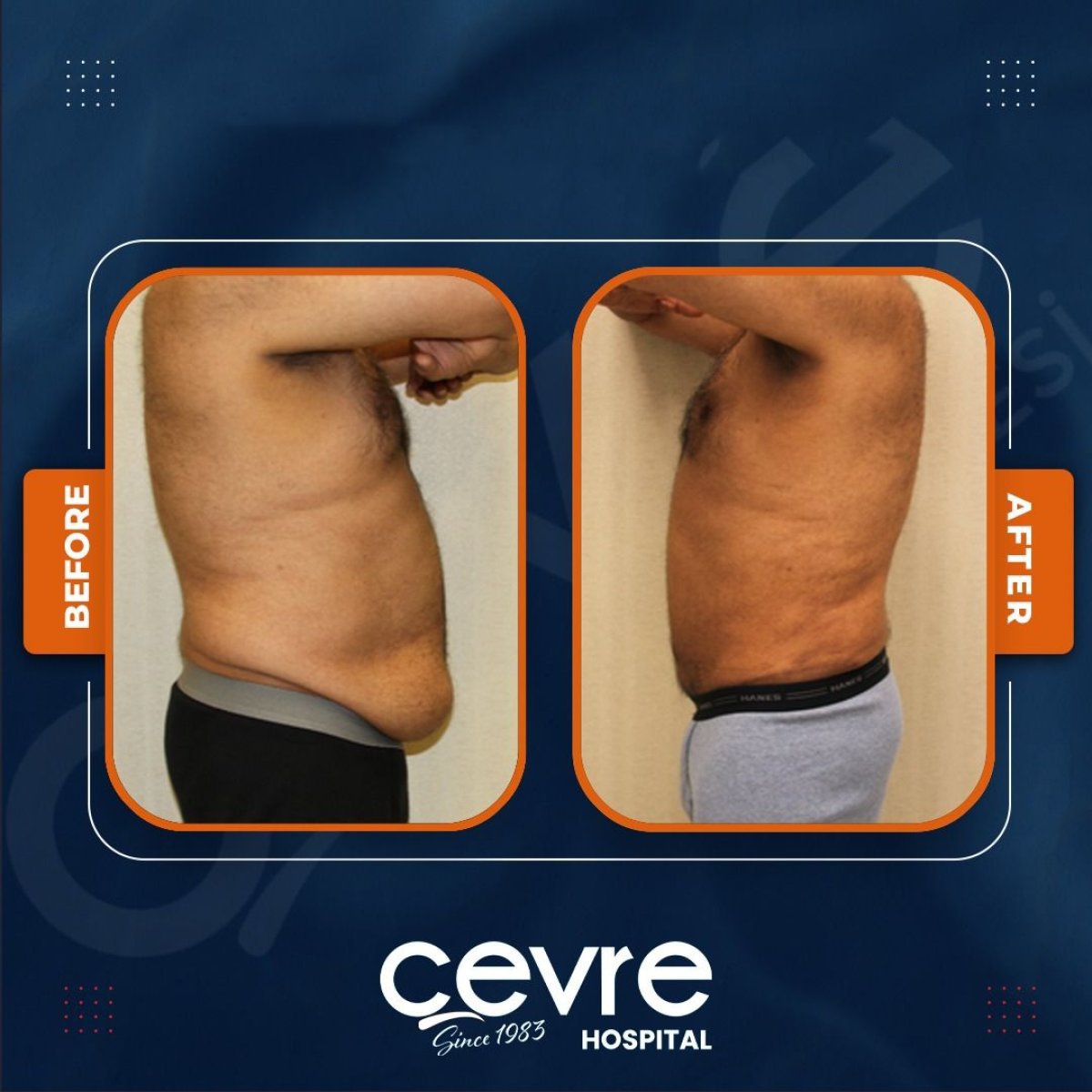 Resultados de abdominoplastia y liposucción antes y después en Adem and Havva Medical Center