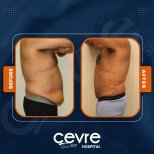 Vorher-nachher-Ergebnisse Bauchdeckenstraffung und Fettabsaugung bei Adem and Havva Medical Center