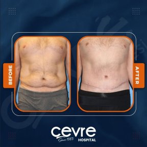 Vorher-nachher-Ergebnisse Bauchdeckenstraffung und Fettabsaugung bei Adem and Havva Medical Center